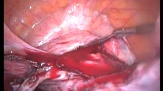 Lap. Assisted Vaginal Hysterectomy LAVH, (unedited)-Abdominal part-1