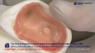 Закрытый синус лифтинг. Применение техники C.M.C IBS IMPLANT