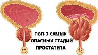 ТОП-3 ОСЛОЖНЕНИЙ ПРОСТАТИТА.m.Uvipe.com