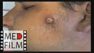 Фурункулы и карбункулы лица © Furuncles and carbuncles face, abscess