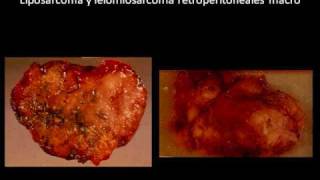 Sarcomas de Partes Blandas1