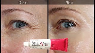 5-Year Retin-A Update ~ Before & After for Wrinkles & Anti-Aging!