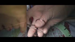 Inflatable penile prosthesis and mini male sling