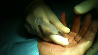 Dupuytren