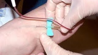 Butterfly Venous cathether placement