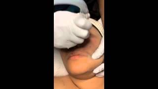 Zenspa San Diego Microdermabrasion Recommendations & Benefits