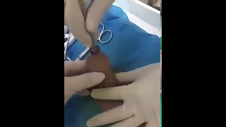 circumcision