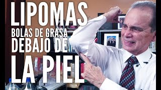 Episodio #1208 Lipomas bolas de grasa debajo de la piel