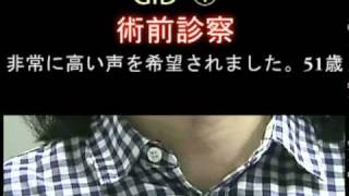 GID （１）　声を高くする（女性化）声帯手術前・手術後