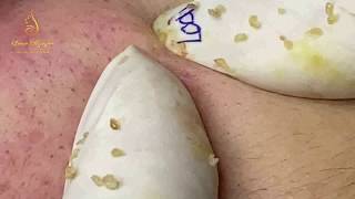 Acne treatment for beautiful bright skin (95) | Loan Nguyen
