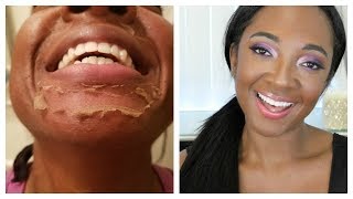 CHEMICAL PEEL Acne Results | Remove Dark Marks, Enlarged Pores & Wrinkles