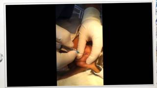 DORSAL PENILE NERVE BLOCK KID