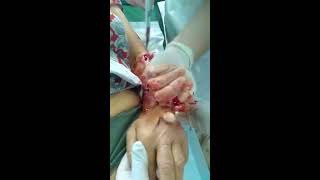 Dog Bite, Infected wound/ укус собаки.Флегмона.