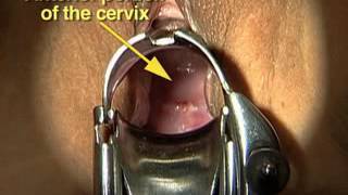 Speculum -   Exam2