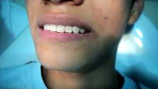 como te quitan los brackets (ortodoncia )