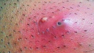 Ingrown Hair 2019 - Best Ingrown Hair Ever