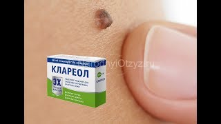 От Бородавок И Папиллом Клареол