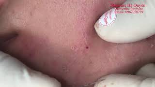 Blackheads and Acne treatment in Ha Quyen Spa on 01/02/2020 - Điều trị mụn tại Hà Quyên spa