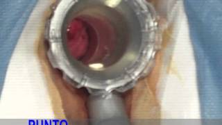 Anoscopio Giratorio Sistema Hemorpex (HPS). Doctor Carlos Sardiñas