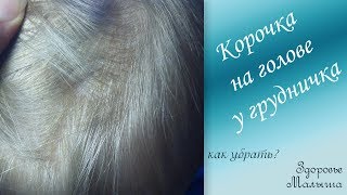 Как убрать корочки на голове у ребенка
