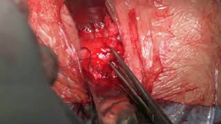Manchester surgery prolapse