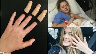 My Amputated Fingers + Prosthetics **WARNING GRAPHIC**