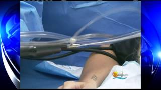 CBS4 Dr Man. Tickle Liposuction