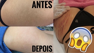 Diário de Beleza | ADEUS ESTRIAS !