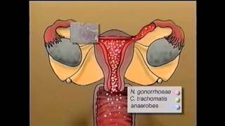 Pelvic Inflammatory Disease Awareness (Original Mix)