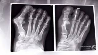 valgus plus купить

  - Valgus Pro оригинал