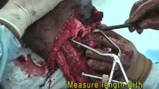 Below Knee Amputation