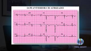 Infarto Agudo no Miocárdio - Diagnostico I 5/10