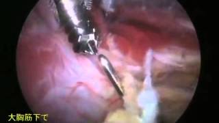 鏡視下バンカート＆ブリストウ法の手術手技（Arthroscopic Bankart & Bristow procedure）