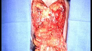 Vulvectomie totale