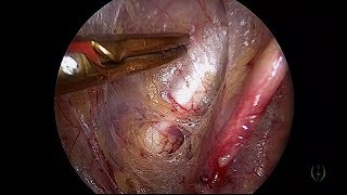 LAPAROSCOPIC PECTOPEXY AND PLICATION OF UTEROSACRALS FOR GRADE 3 UTERINE PROLAPSE