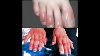 علاج تورم اليد والقدم فى الشتاء| عضة البرد |frostbite| Treatment of cold limbs