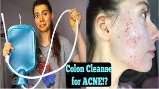 I TRIED AN ENEMA FOR ONE WEEK FOR MY ACNE || The shocking outcome..