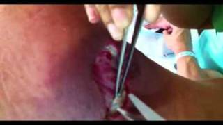 Curing the wound