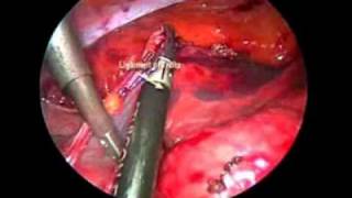 Laparoscopic Ladd's procedure for treatment of adult presentation of congenital intestinal malr