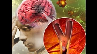 Cải thiện di chứng sau tai biến mạch máu não đột quỵ liệt nữa người