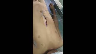 Postmortem examination/autopsy of a child victim of RTA