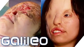 Das Mädchen mit dem neuen Gesicht | Galileo | ProSieben