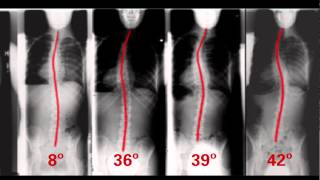 The True Cost of Delaying Scoliosis Treatment