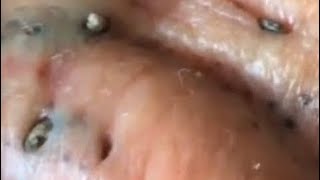 Blackheads behind his ear.Thank you for watching.