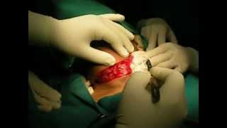 Thyroid Surgery- Part 1- Subtotal Lobectomy Big Thyromegaly Rt Lobe Thyroid - Dr Narotam Dewan