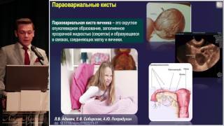 23 апреля 2017 г. Лекция "Опухоли гениталий у детей. Что дает диспансеризация"