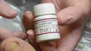 Онихомикозная чистка