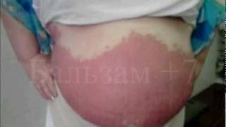 psoriaz Реальное лечение псориаза бальзам+7