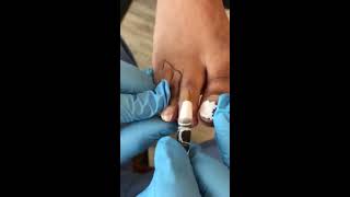 Webbed toes surgery