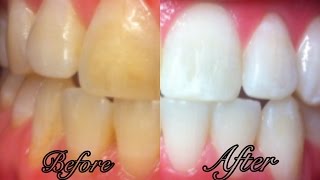 How To Whiten Teeth at Home